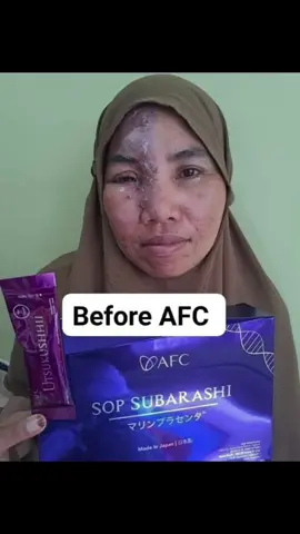 MAU TAU RAHASIA KULIT BEBAS DARI ALERGI .?? YESSS PRODUK AFC (SUBARASHI DAN UTSUKUSHHII) DAN SERUM SENSEI SURU JAWABANNYA ❣️... DM FOR MORE INFO #realtestimoni  #produkcuan  #tiktokindonesia  #afclifescience  #afclifescienceindonesia  #utsukushhii  #salmonovarypeptide  #senseisuruserum  #subarashi @eyahealthystore 