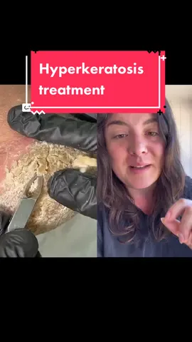 #duet with @PusAttack hyperkeratosis removal #parmeseanpalms #dermatology #podiatry #podologia #callousremoval #footcallusremoval #podiatrylife #dermatologia 