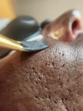 Carbon peeling - Q kapcsolt Nd Yag lézerrel 🪄 Carbon peeling kezelés miteszeres, aknés, tág pórusú és gyulladt bőrökre! NYÁRON is végezhető kezelés 🫶🏻 Az első alkalom után 15%-os javulás következik be az aknék és a leglátványosabb pórusok mérete jelentősen csökken. A negyedik kezelés után 60%-os javulás érhető el a gyulladás, bőrtextúra, faggyútermelődés, és a pórusméret terén. Jól látható a kollagénrostok összehúzódása, a bőr sokkal feszesebbé válik, elkezdődik a teljes újrastruktórálódás és a bőr menyugszik. A kezelést szalonunkban szakképzett kozmetikus kolleganőnk végzi 🫶🏻 @Klau Dobák ♥️ #carbonpeel #hollywoodpeel #talentumbeautyteam 