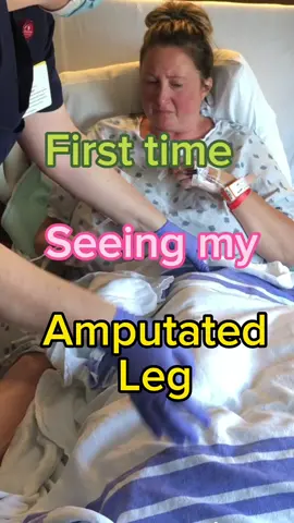 For my 2 year #amputation anniversary, I want to show that EVERYONE starts at the beginning.  Its easy to see me 2 years post amputation runiing around living life, but i was so heartbroken and so terrified of my #electiveamputation that they had to literally knock me out waiting for surgery.  This is not easy. No part of being an #electiveamputee is easy.  The decision to amputate is excruciating. The amputation is painful and depressing. The learning phase is grueling. But there is life on the other side if you dont give up. Dont compare your story to anyone else. And DONT give up!  If you are facing this awful decision, i have so many resources for you! 💕