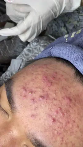 A quantidade de acne que tinha nessa pele. . #cravos #cravoseespinhas #limpezadepele #tirarcravos #satisfatorio