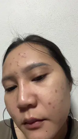 5 เดือน รู้เรื่อง!!!! #รีวิวบิวตี้ #วิตามินซี #รีวิวฉบับคนเป็นสิว 