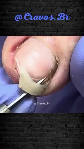 Tratamento 310 - #blackhead #unha #tratamento #cravoseespinhas #acne #cravos #tiktok #foryoubrasil 
