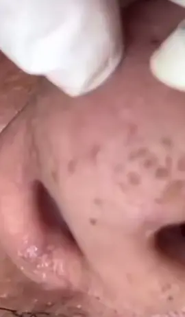 #blackheads #extractions #satisfying #removal 