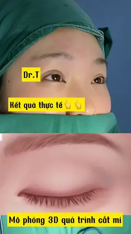 #nangmui #nangmuiphongthuy #catmi #congai #lamdep #tiktok #xuhuong #dr_thịnh👨🏻‍⚕️  