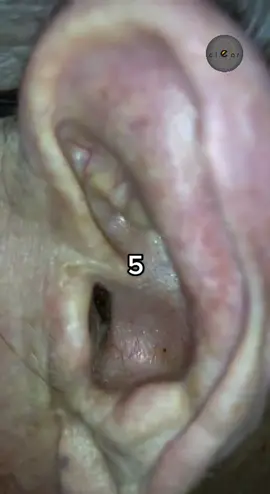 Guess how long he hasn’t cleaned his ears#earwax #earwaxremoval #satisfying #foryou #fyp#earcleaning #earcleaningtool #earwaxremoval #earcamera 