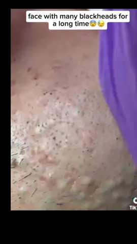 #blackhead #pimple366 #satisfying #pimplestreatment #pimple 