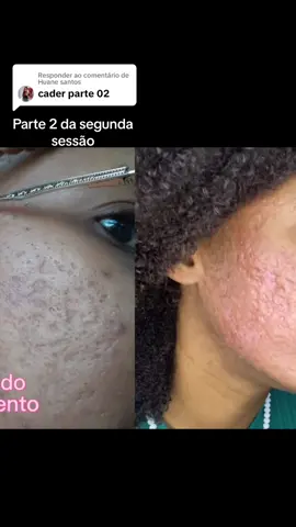 Respondendo a @Huane santos  tratamento para cicatrizes de acne (parte 2 da primeira sessão) #refineskin #peeling #peelingquimico #fenol #skin #medico #fy #medicina #antesdepois #estetica #beleza #cicatrizesdeacne #esteticista #dermatologia #reidofenol #phenolgold #tratamentoparacicatrizes #estéticafacial #estética #biomedicinaestética 