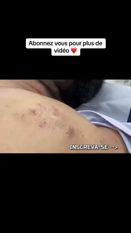 #blackhead #pimple366 #satisfying #pimplestreatment #pimple 