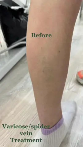Treat varicose veins or spider veins in as little as two sessions  #healing #varicoseveins #varicoseveintreatment #spiderveins #spiderveintreatment #cheshire #cheshiretherapist 