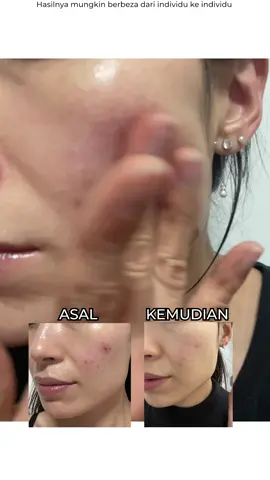 92% Snail Mucin Repair Skin After Breakouts 🐌🐌🐌 #snail #snailmucin #snailcream #snailessence #musthave #cosrx #fyp #fypage #fypviral #skincare #skincaretips #beautytips #skincaremalaysia #skincarekorea #cosrxkorea  #cosrxmalaysia #thankyoutiktok #thankyousupport #produkviral #productviraltiktok #produkviraltiktokshop 