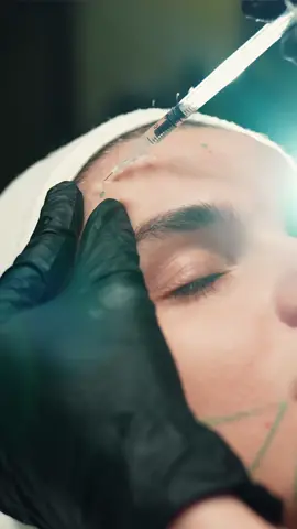 Botox is a great option for anyone looking to achieve a more youthful and refreshed appearance without undergoing surgery. It’s a safe and effective treatment that has been used by millions of people worldwide. Our clinic uses only the highest quality Botox products and follows strict safety protocols to ensure your satisfaction and safety. #lueurclinic #aestheticclinic #aesthetic #skincare #skingoals #dubai #dubaireels #beautyreels #botox #botoxdubai #antiwrinkles