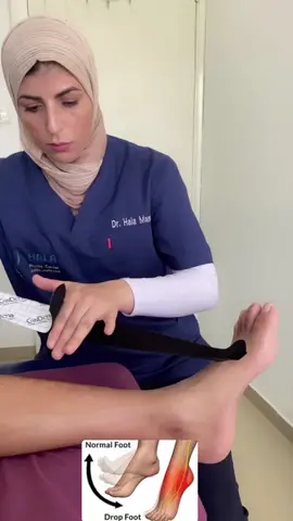 الأشرطة الطبية اللاصقة لحالة تدلي/إراحة القدم  kt Tape For Drop foot 🦶  تدلي القدم هو أحد الأعراض التي تقوم فيها بسحب أصابع قدمك عند المشي بسبب ضعف أو شلل بعض عضلات قدمك. له عدة أسباب محتملة. الأسباب الأكثر شيوعًا هي إصابة العصب الشظوي (فرع من العصب الوركي) واعتلال الجذور القطنية. Foot drop is a symptom in which you drag your toes when you walk due to weakness or paralysis of certain muscles in your foot. It has several possible causes. The most common causes are peroneal nerve injury (Sciatic Nerve Branch) and lumbar radiculopathy. #kttape kttapefordropfoot #dropfoot #sciaticnerve #physiotherapy #فلسطين_لبنان_سوريا_اليمن_مورتانيا  #بيت_لحمم_فلسطينن_القدس💚😍  #بيت_لحم_فلسطين 