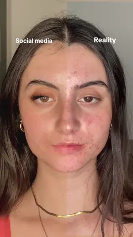 Your reminder that social media is fake! Breaking down the walls of beauty standards one flaw at a time on @LoudTalk Podcast ❤️🥰 #skincare #acnepositivity #skinpositivity #realskin #beautystandard #socialmediavsreallife #texturedskin #makeup #unfiltered 