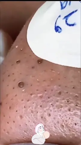 #blackhead #pimplepoppersatisfying #pimple #acne #nose 