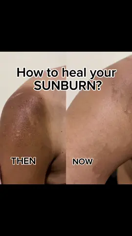 Sunburn 🥵 Aloe Vera Soothing Gel is heaven sent 🤩😇 #luxeorganix #aloevera #soothinggelaloevera #fyp #sunburn 