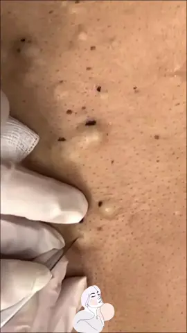 #cyst #acne #pimple #pimplepoppersatisfying #skincare #blackhead 