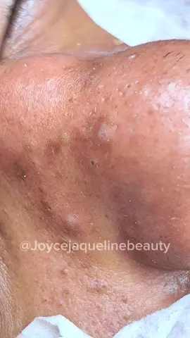 Cada cravao 😳 #cravononariz #fy #cravolovers #satisfatóriosvideos #poppingpimples #poppingpimples #satisfying #videosatisfatorio #limpezadepele #cravoseespinhas 