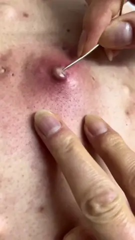 Very big pimple #pimplepop #pimpleremover #pimplepopping #squeezepip #pimpl #bigpimple #pimplepopper 