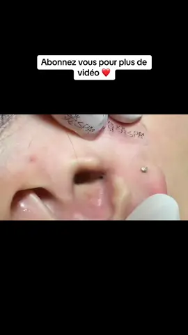 #longervideos #blackhead #pimple366 #satisfying #pimplestreatment #pimple 