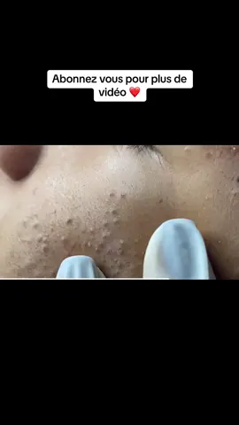 #longervideos #blackhead #pimple366 #satisfying #pimplestreatment #pimple 