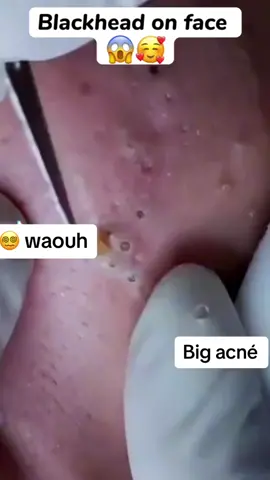 #longervideos #blackhead #pimple366 #satisfying #pimplestreatment #pimple 