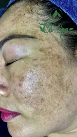 Nám sau sinh sau 3 tháng #Cỏ_spa_chăm_sóc_da_khoa_học #đào_tạo_spa #Điều_trị_nám 