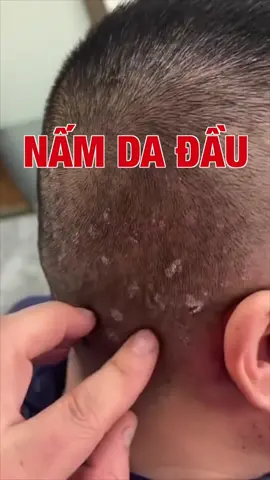 Hỗ trợ trị nấm da đầu mùa mưa chuẩn chuyên gia đến từ iCare Pharma #xuhuong #trending #icarepharma #ngayhoitieudung #daugoitrigau #daugoitrinam
