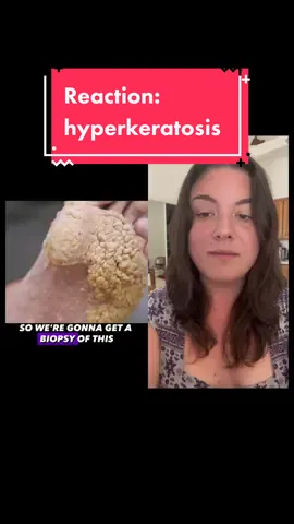 #duet with @Doctor Cha actually from @tlc i believe #parmeseanpalms #callousremoval #footcallusremoval #callousedfoot #footcallus #podiatrylife #podologia #dermatologia #podiatry #dermatology 