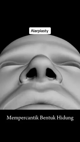 Alarplasty, make your nose beuty🥰 💯Booking now ⬇️⬇️⬇️ ☎️ Whatapp :017-9451645  #baby_love_aesthetics #cosmetics#surgery#Rhinoplasty#nâng mui#breastaugmentation #Filler#botox #liposuction #alarplasty#beauty #doubleeylid #browlift #breastlift#tummytuck #kuchailama #kualalumpur#tiktok 