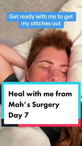 Come with me to get my stitches out on day 7 of recovering from #mohssurgery  Finding out I had #basalcellcarcinoma getting it removed and being left with a face full of stitches has really put a lot into perspective for me.  Not only will I need laser therapy to reduce the scaring I will need real therapy to heal from the trauma  I cant stop thinking about one of my favorite movies, Fight Club. When Tyler Durden says, “I dont wanna die without any scars”  #cancerfree #HealingJourney #scarred #healwithme #icehat #grwm 