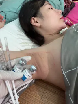 Một ca tiê.m triệt tuyến mồ hôi nách hiệu quả 95-100% cho khách nhiều mồ hôi nha 