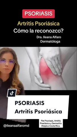 #psoriasis #artritis #artritispsoriasica #piel La psoriasis en el 40% de los casos puede manifestarse como artritis psoriásica. Aquí puedes conocer sus síntomas. 
