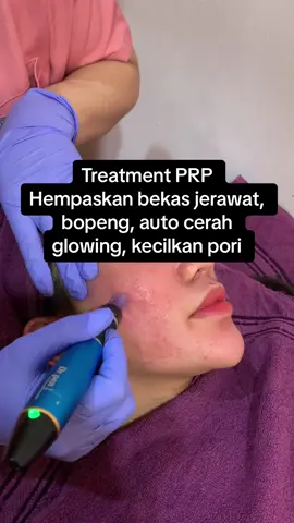 Siapa yang belom cobain prp? Hayooo