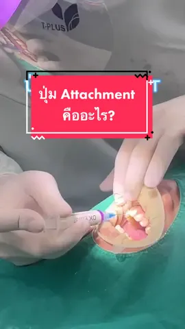 ปุ่ม Attachment คืออะไร⁉️  #รีวิวจัดฟันใสcrystalsmile #crystalsmile #จัดฟันใสราคาไม่แพง #จัดฟันใสcrystalsmile 