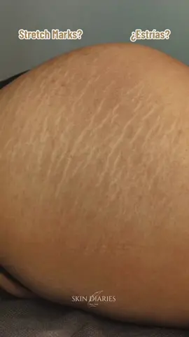 Stretch marks on your glutes? Try the inkless camouflage tecnique to fade the appearance of your stretch marks.  ✔️Improvements in color  ✔️improvements in textures ✔️Changes up to 90%  ✔️Stretch marks will be able to tan after treatment ✔️Permanent changes —————— Estrías en tus glúteos?  Trata tus estrías con el metodo “Camuflaje Sin Tinta”  ¿Qué lograremos? ✔️Mejorar el color de estrías  ✔️Mejorar la texturas de estrías  ✔️Cambios hasta un 90% ✔️Las estrías podrán broncearse después del tratamiento ✔️Cambios permanentes . . . #newyorkstretchmarkcamouflage #stretchmarksnewyork #fakebody⚠️ #stretchmarktreatment #camuflajedeestrías #camuflajedeestríassintinta #estriasbrancas #estrías #fyp #foryoupage #trend