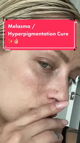 I really hope this helps someone out there 🥹❤️ my face is not perfect but its better and that’s what matters. Skin care is so important as we show our face to everyone we meet! It isnt vain to care for yourself ❤️❤️❤️ #melasma #skincare #skincaretips #dermatologist #hydroquinone #tretinoin #skincareproducts #beautyhacks #microneedling #facecare 