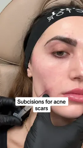 FINALLY something that works for acne scars! I've done multiple sessions of microneedling & chemical peels... nothing has worked. But this is the first time I've actually noticed improvement. Thank you @TheOrlandoInjector_ for working your magic once again 🥹🤍 If y'all visit Alexis for your subcisions, make sure to mention my name so you can get $50 off (:  #acnescars #acnescartreatment #acnescar #acnescarsremoval #acnescarring #pittedacnescars #icepickscars #boxcarscars #deepacnescar #acne #acnetreatment #acneskin #subcision #subcisiontreatment #sculptra #sculptrafiller 