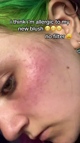 how do i fix this 😭 #blush#blushfail#allergic#allergy#sensitiveskin#halseymakeup#hives#makeup#makeupfail#fyp#fyyyyp#fyppp