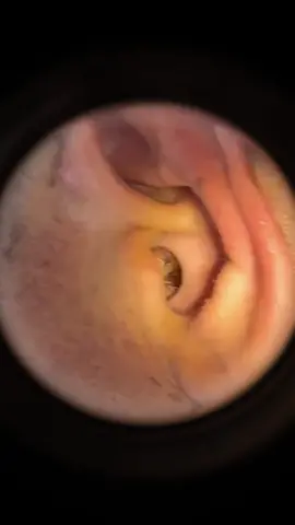 Guess how long it’s been since his ears were cleaned ?#ear #earwax #earwaxremoval #earwaxcleaning #earwaxremmoval #earwaximpaction #satisfying #relax #relaxing #relaxingvideos #foryou #fpyシ #fpy 