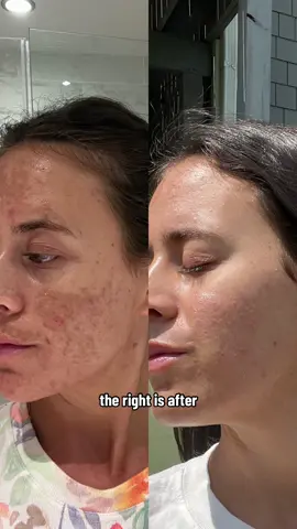 Im so happy with my results I could cry!! I have seriously tried eveything and @Musely is the only thing thats worked so far. I highly highly reccomend! #muselyjourney #muselypartner #muselyworks #melasmacure #melasmatok #hyperpigmentationtreatment 