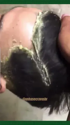 #caspa #dermatitisseborreica #foryou #viral #relaxing #blackheads #satisfyingvideosdaily #fyp #unhaencravada #ingrowntoenail 