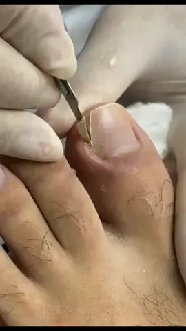 unha encravada 😱 #Kukukakiyangtumbuhkedalam #Ingrowntoenail #Вросшийноготь #巻き爪 #Uñaencarnada #내향성발톱 #趾甲内生 #unhasencravadas #podologia #podologas #ingrowntoenail #podiatry 