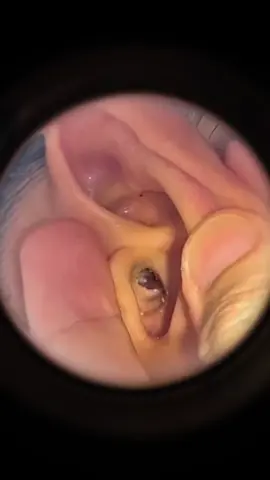 Guess how long it’s been since his ears were cleaned ?#ear #earwax #earwaxremoval #earwaxcleaning #earwaxremmoval #earwaximpaction #satisfying #relax #relaxing #relaxingvideos #foryou #fpyシ #fpy 