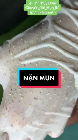 #nặn_mụn #lêthithuydung616 #chuyên_đtri_mụn_rỗ_tpvinh_nghệan #mdspa_chuyên_mụn_rỗ_tpvinh 