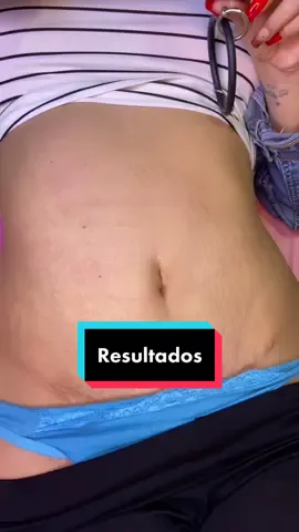 Hermoso proceso 🥰 #micropuntura #estrias #venezuela #embarazo 