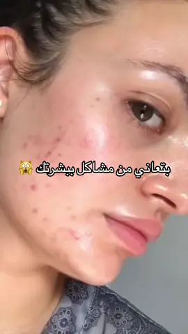 حبوب او اثار حبوب مسام واسعه او حتى كلف و تصبغات كلشي في اله حل بمنتجات طبية مرخصه من وزارة الصحة ❤️  ابعتيلي لنلاقي حل لمشكلتك شو بتستني ❤️  متوفر منتجات طبية مرخصة من وزارة الصحة + استشارة مجانية لحالة البشرة 🌸  متوفر خدمة توصيل لجميع مناطق الضفة و القدس و الداخل 🚕 #اكسبلور #fyp #foryou #ترند #ترند_تيك_توك #عناية_بالبشرة #بشرة #مالي_خلق_احط_هاشتاقات #روتين_العنايه_بالبشره  .