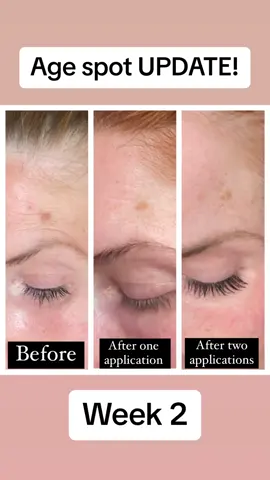 Week 2 update 🙂 so impressed! ❤️  #agespotremoval #skincare #skincaretips #antiaging #theordinary #antiagingskincare @The Ordinary  