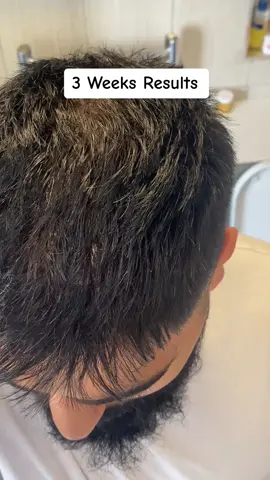 My Hair Loss Fix✨ #fyp #foryou #foryourpage #trending #viralvideo #hairloss #hairlossremedy #hairlosssolutions #haircare #menhair #rosemaryoil #desi #alopecia #asianboy 