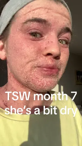 Imagine being this hot AND this dry !  #topicalsteroidwithdrawal #tsw #skincondition #healing #thisisnoteczema 